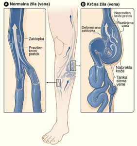 Veska Insuficienca (Krčne žile – bolezni ven na nogah)