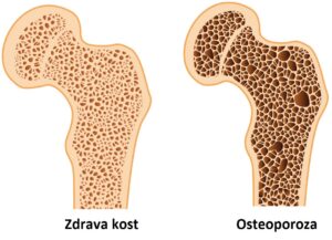 OSTEOPOROZA